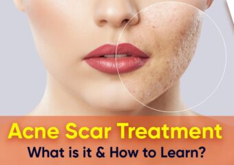 Acne Scar Treatment – What is it & How to Learn?