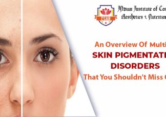 AN OVERVIEW OF MULTIPLE SKIN PIGMENTATION DISORDERS THAT YOU SHOULDN’T MISS OUT ON