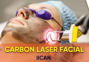 Carbon Laser Facial   IICAN