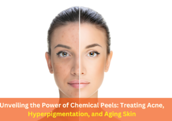 The Use of Chemical Peels in Treating Acne, Hyperpigmentation, and Aging Skin: Exploring the Benefits and Advancements