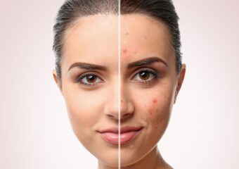 Rejuvenating Skin: Unveiling Best Practices in Clinical Cosmetology for Acne and Scarring Treatment