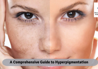 A Comprehensive Guide to Hyperpigmentation