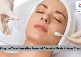 Unveiling the Transformative Power of Chemical Peels in Acne Treatment