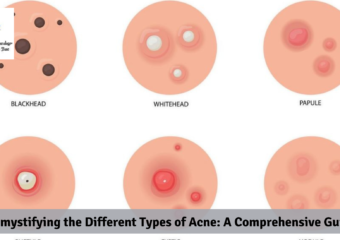 Demystifying the Different Types of Acne: A Comprehensive Guide